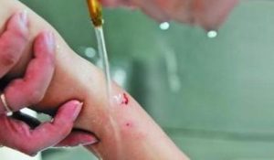 被狗狗抓伤怎么办?被四个月狗狗抓伤怎么办-警犬训练器材厂家 _警犬训练用品_工作犬训练用品-南京开久警犬装备